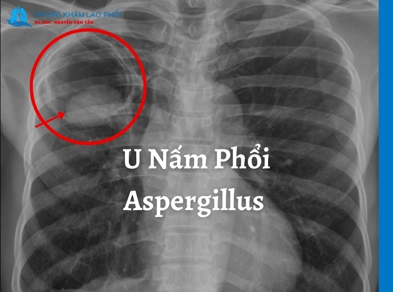 U Nấm Phổi Aspergillus là gì? Nguyên nhân, dấu hiệu và điều trị